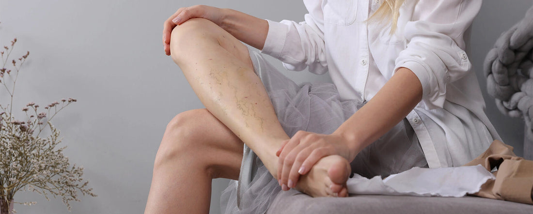 Natural treatment and Prevention of varicose veins: Effective methods and products